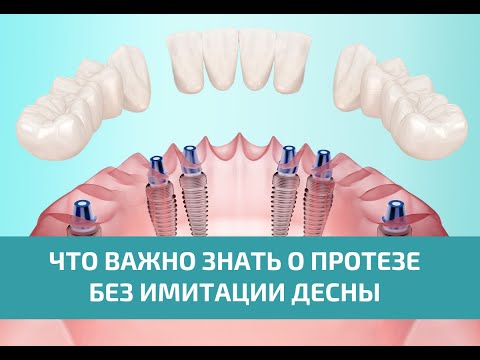 Видео: Протезирование на имплантах без имитации десны