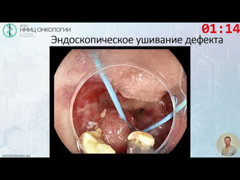 Видео: Случай лечения крупной опухоли двенадцатиперстной кишки