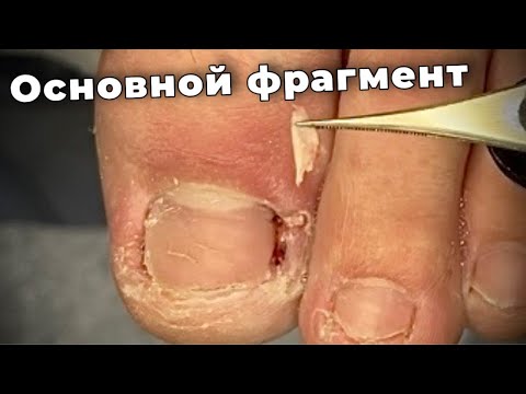 Видео: Осложнил работу закинув ногу на ногу. Найти последнюю вросшую часть. 