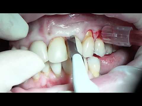 Видео: Мария Александровна Носова. Устранение рецессии по методу Зуккелли. Эпизод 1.