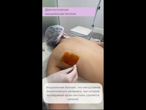 Видео: Диагностическая эксцизионная биопсия #дерматология #биопсия