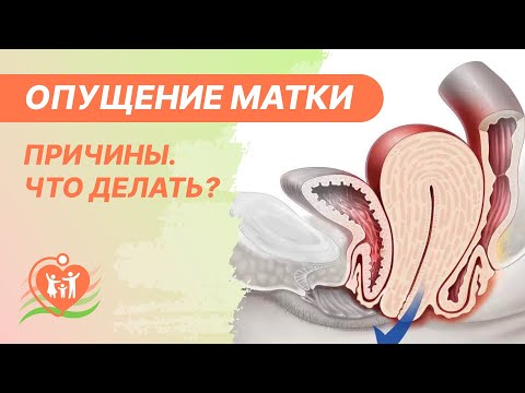 Видео: ⭕ Опущение матки. Причины. Чем грозит опущение или выпадение матки и что делать?