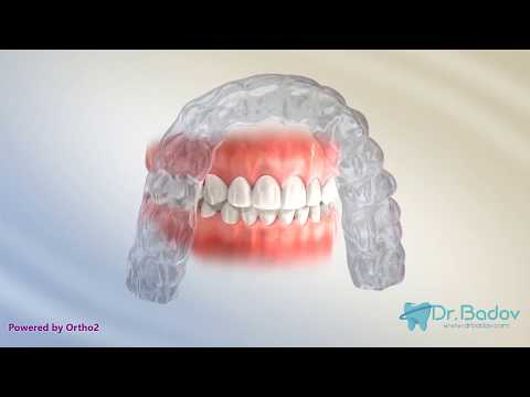 Видео: #ортодонт #брекети #ритейнър  Ритейнър след брекети