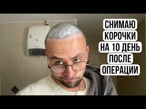 Видео: СНЯТИЕ КОРОЧКИ НА 10 ДЕНЬ ПОСЛЕ ПЕРЕСАДКИ ВОЛОС