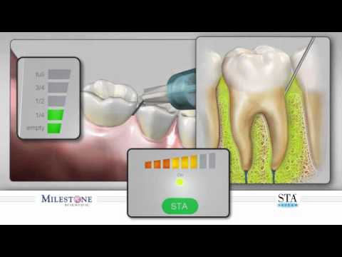 Видео: Интралигаментарная анестезия