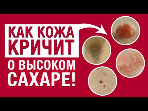 Видео: Самый БЫСТРЫЙ тест на глюкозу в крови / Как выявить САХАРНЫЙ ДИАБЕТ по коже?
