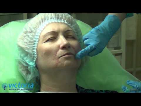 Видео: Контурная пластика препаратом Радиесс (RADIESSE)