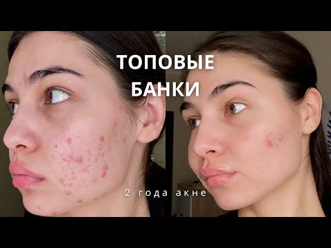 Видео: МОЙ ОСЕННИЙ УХОД | ЛЕЧУ АКНЕ С ДЕРМАТОЛОГОМ