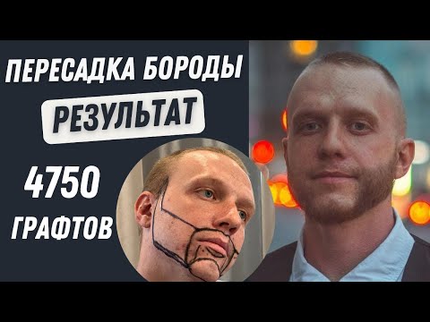 Видео: Пересадка Бороды Результат | Пересадка Бороды До и После | Пересадка Бороды в Турции Отзыв