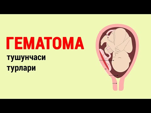 Видео: Гематома турлари