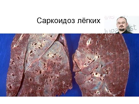 Видео: Саркоидоз лёгких – что это такое