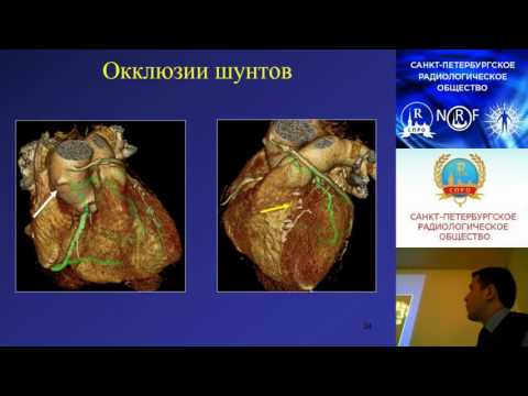 Видео: Меньков И.А. КТ в оценке состояния коронарных шунтов и стентов