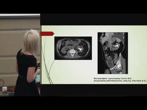 Видео: Нестерова Е.С., Особенности лечения больных фолликулярной лимфомой с сопутствующей патологией..