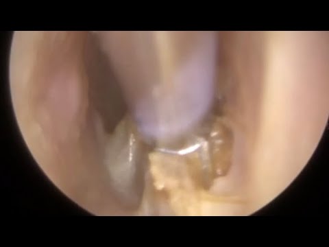 Видео: 857 - Инфекция опухшего уха и удаление ушной серы