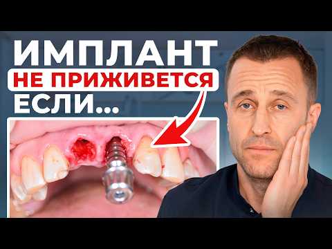 Видео: С этим сталкивается 90% людей после имплантации! Самые частые жалобы после установки имплантов!
