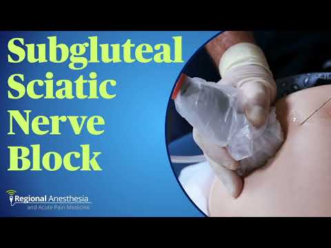 Видео: Блокада сідничного нерва підсідничним доступом