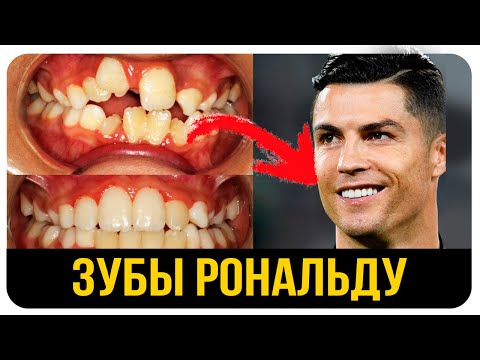 Видео: Кривые Зубы Криштиану Рональду. До и После. Сколько Стоят Виниры? Зубы Знаменитостей.