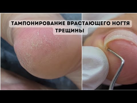 Видео: ARAVIA. Педикюр на проблемных ногах. Тампонирование кополином и смарт педикюр диском.