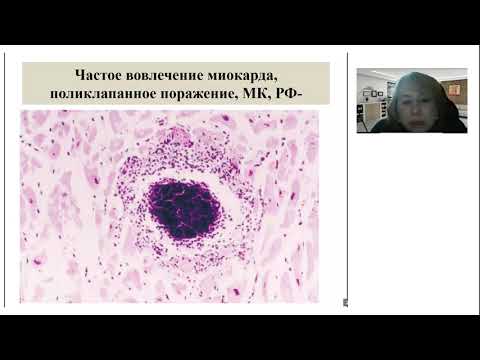 Видео: Школа клинического мышления педиатра. Инфекционный эндокардит у детей и подростков