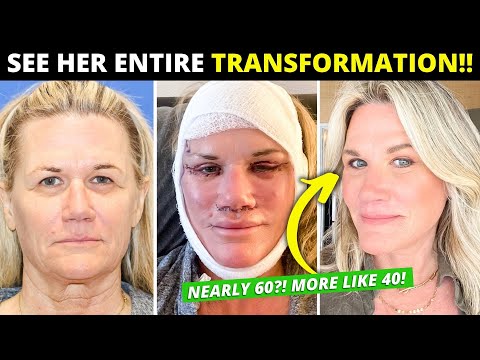 Видео: Подтяжка лица в почти 60 лет изменила всю её жизнь! Радикальная вертикальная восстановительная оп...