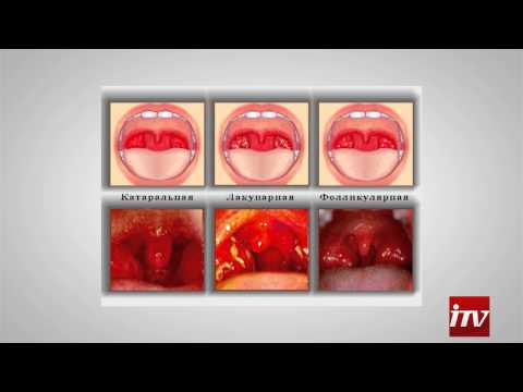 Видео: Ангина