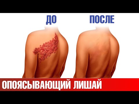 Видео: Опоясывающий лишай: лучшая стратегия👉атака изнутри и снаружи