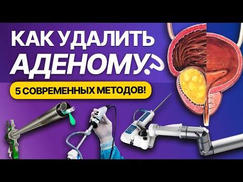 Видео: Большая аденома простаты. Пять эффективных способов удаления. Осложнения, преимущества и недостатки