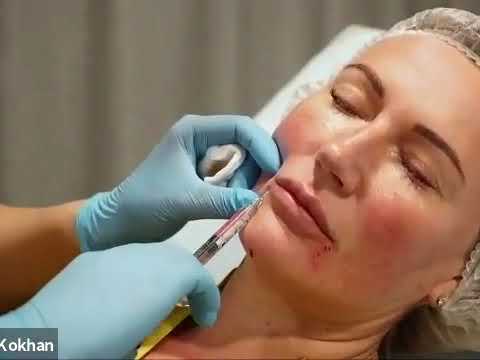 Видео: Коррекция нижней трети лица филлером Neauvia Intense LV
