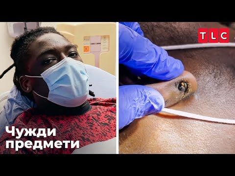 Видео: Не мога да сваля обецата си с клещи | Чужди предмети