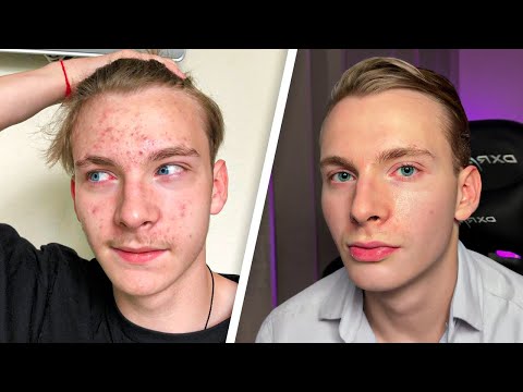 Видео: Как Я Вылечил АКНЕ