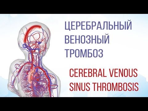 Видео: Церебральный венозный тромбоз / Cerebral Venous Sinus Thrombosis