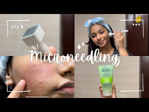 Видео: Избавьтесь от шрамов от угревой сыпи || Обновление по микронидлингу