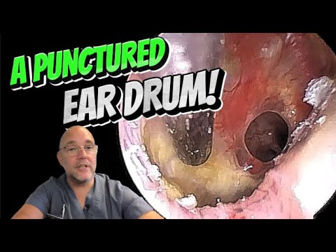 Видео: ПРОКОЛ БАРАБАННОЙ ПЕРЕПОНКИ! 336 #ухо #ушнаясера #удалениеушнойсеры #asmr #удовлетворение #длявас...