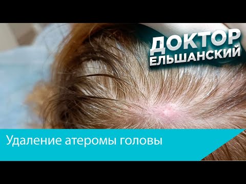 Видео: Удаление атеромы головы