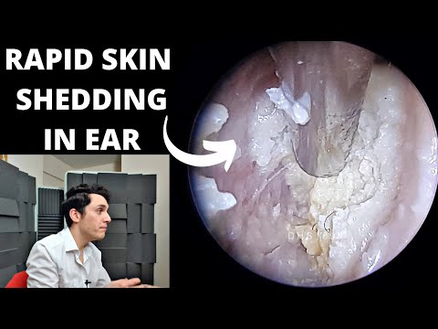 Видео: Быстрое отшелушивание кожи. Очищение ушей с помощью отсасывания (аутоиммунное или инфекционное?)