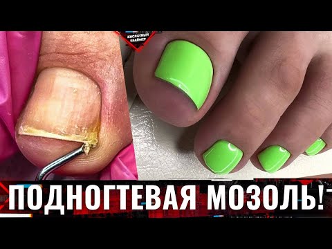 Видео: 😭УСТАЛА МУЧАТЬСЯ! У клиентки СНОВА ПОДНОГТЕВАЯ МОЗОЛЬ!😫 Педикюр лето 2023😍 Наш отзыв на 4blanc