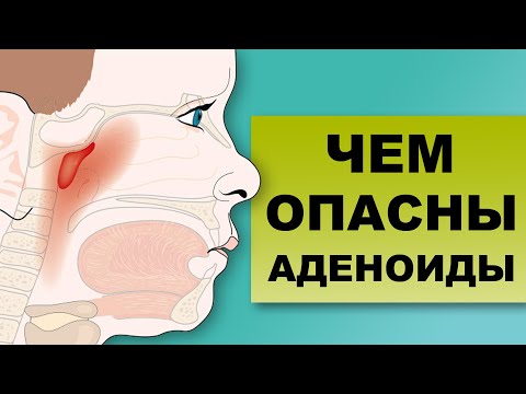 Видео: ЧЕМ ОПАСНЫ УВЕЛИЧЕННЫЕ АДЕНОИДЫ?