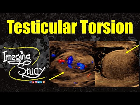 Видео: Перекрут яичка | Ранняя подострая стадия || УЗИ || Случай 358