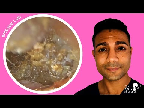 Видео: 1482 — Плановое удаление ушной серы выявляет гиперплазию эпителия слухового прохода