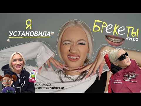 Видео: VLOG: Я ПОСТАВИЛА БРЕКЕТЫ! *первые ощущения* первый месяц с ними…