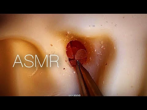 Видео: ASMR Удаляет комки ушной серы с отличным визуальным покалыванием❤️