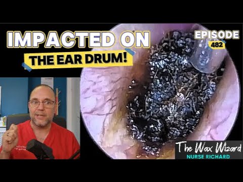 Видео: ПОВРЕЖДЕНИЕ БАРАБАННОЙ ПЕРЕПОНКИ! Эпизод 482