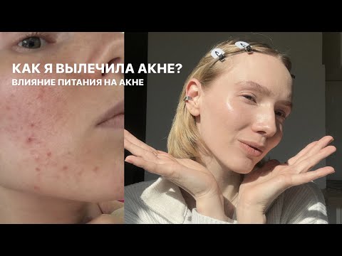 Видео: 18; КАК Я ИЗБАВИЛАСЬ ОТ ПРЫЩЕЙ? ПЛАН ЛЕЧЕНИЯ АКНЕ. Питание и акне. Мой путь к жизни без прыщей.