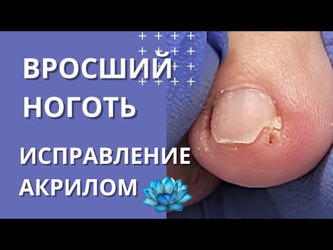 Видео: Лечение вросшего ногтя на пальце ноги.