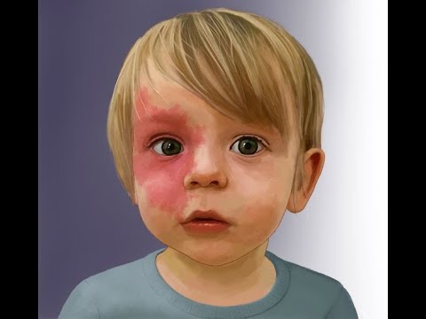 Видео: 15 фактов о капиллярных мальформациях (ангиодисплазиях)