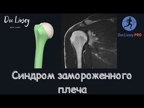 Видео: Синдром замороженного плеча