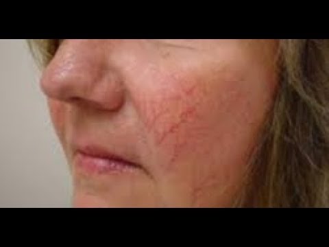 Видео: АПТЕЧНЫЕ СРЕДСТВА от КУПЕРОЗА.