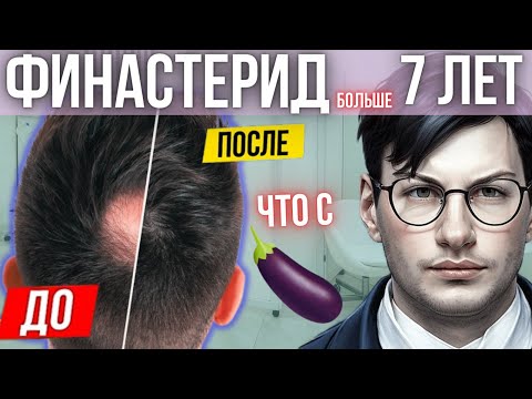 Видео: ДЕЛАЛ ЛИ ПЕРЕРЫВЫ? СТОИТ ЛИ? ВЛИЯНЕНИЕ ФИНАСТЕРИДА за 7 лет. Мои побочки | ФИНАСТЕРИД ОТ ОБЛЫСЕНИЯ
