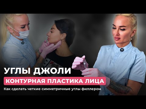 Видео: Углы Джоли. Контурная пластика лица. Как сделать четкие симметричные углы филлером