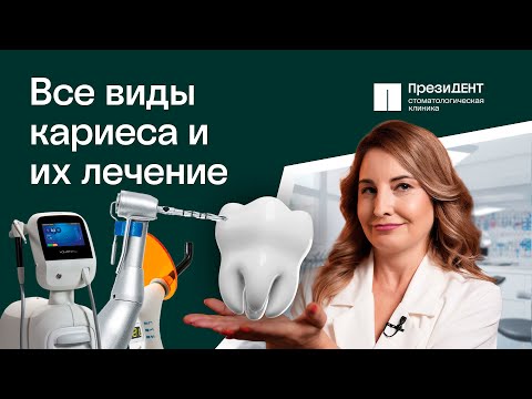 Видео: Кариес - симптомы, виды, как выглядит. Как лечить кариес без сверления? | ПрезиДЕНТ 💚